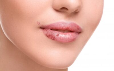 Herpes labial