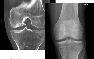 ¿Qué es la Osteocondritis?