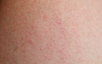 Rash alérgico