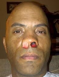 Todo acerca de la Epistaxis